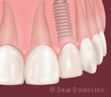 dental-implants25