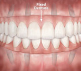 fixed-denture